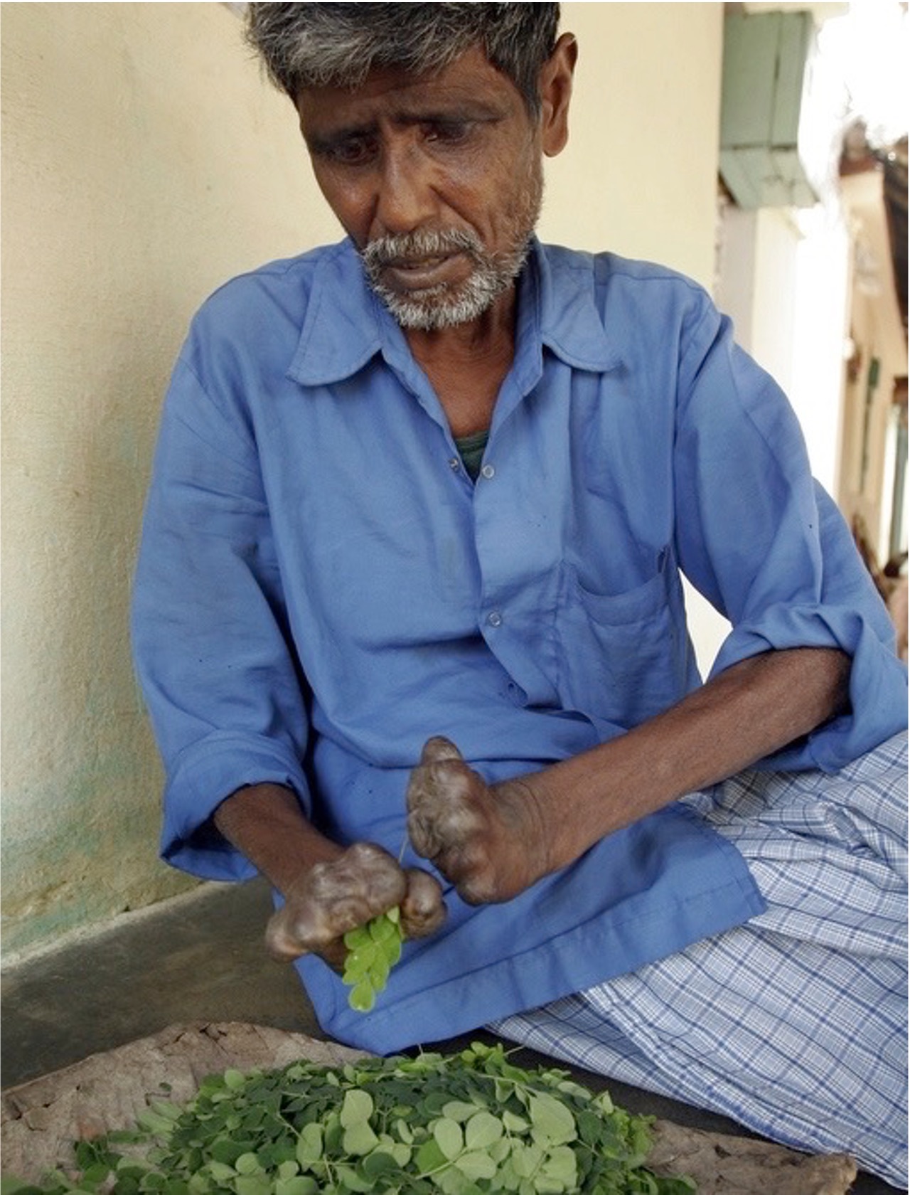 Becky Douglas on Transforming Leprosy Colonies in India - Family Office ...